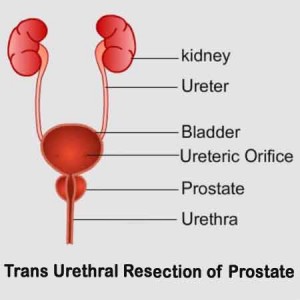 Trans Urethral Resection of Prostate (TURP)