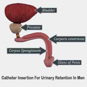 Catheter Insertion For Urinary Retention In Men