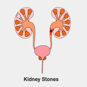 Kidney Stones - Colics Due To A Moving Kidney Stone
