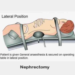 Surgical Removal Of Kidney Or Nephrectomy