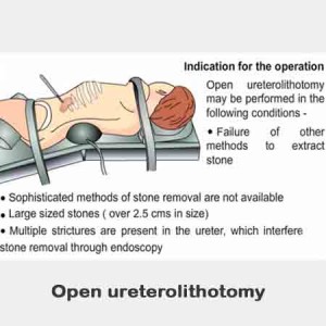 Open Ureterolithotomy