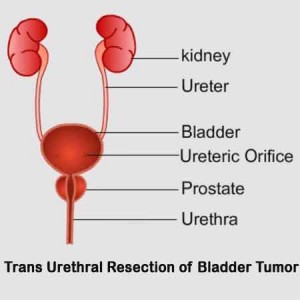 Trans Urethral Resection of Bladder Tumor (TUBRT)