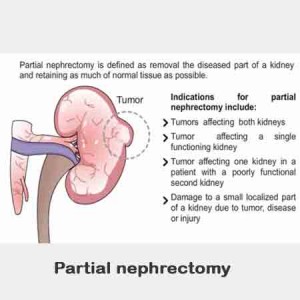 Partial nephrectomy